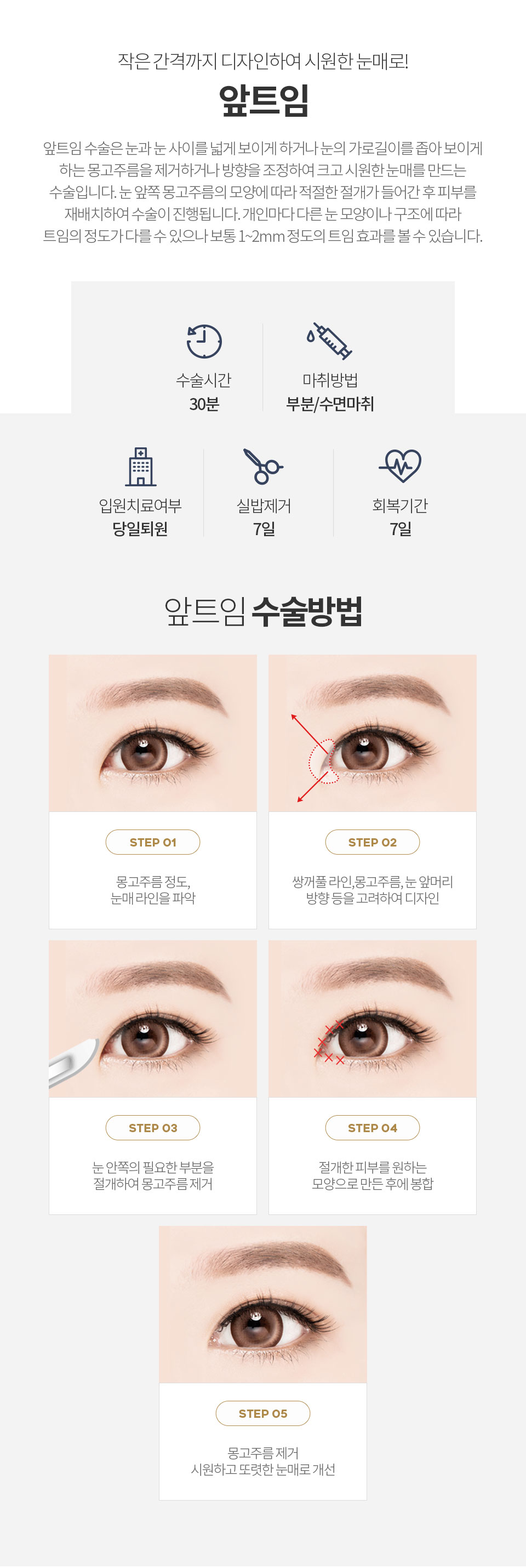 자연유착 최소절개 매몰법